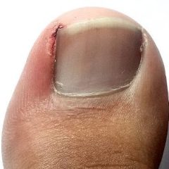 what-is-an-ingrown-toenail